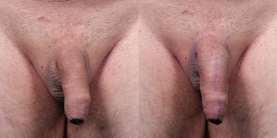 Penis Enhancement Before & After Gallery - Patient 292021 - Image 1