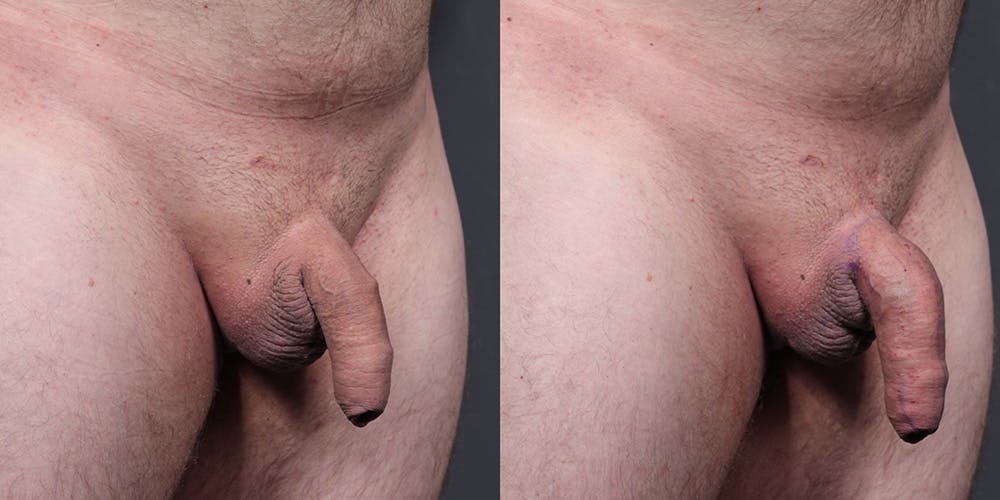 Penis Enhancement Before & After Gallery - Patient 292021 - Image 2