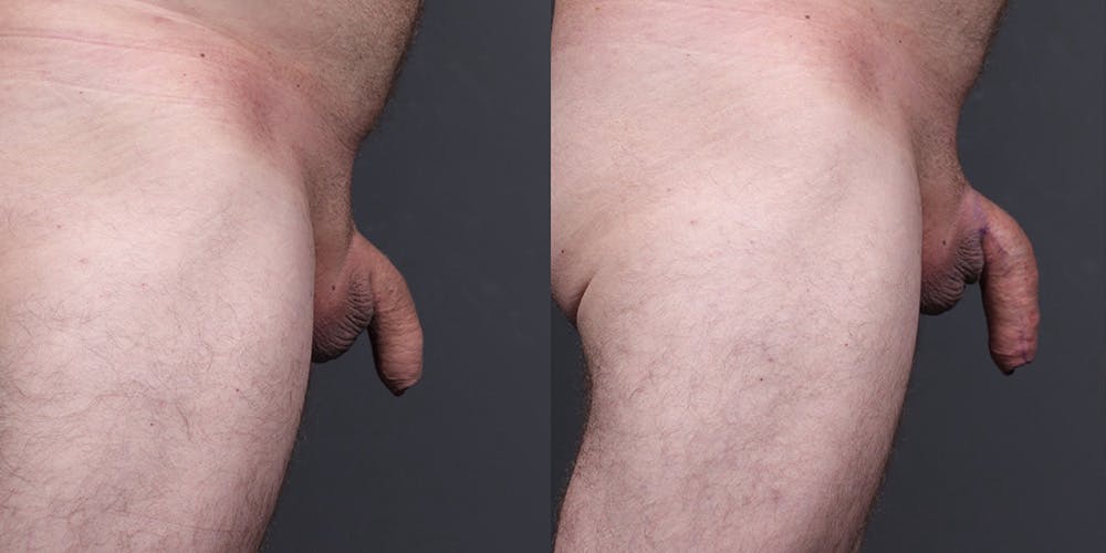 Penis Enhancement Before & After Gallery - Patient 292021 - Image 3