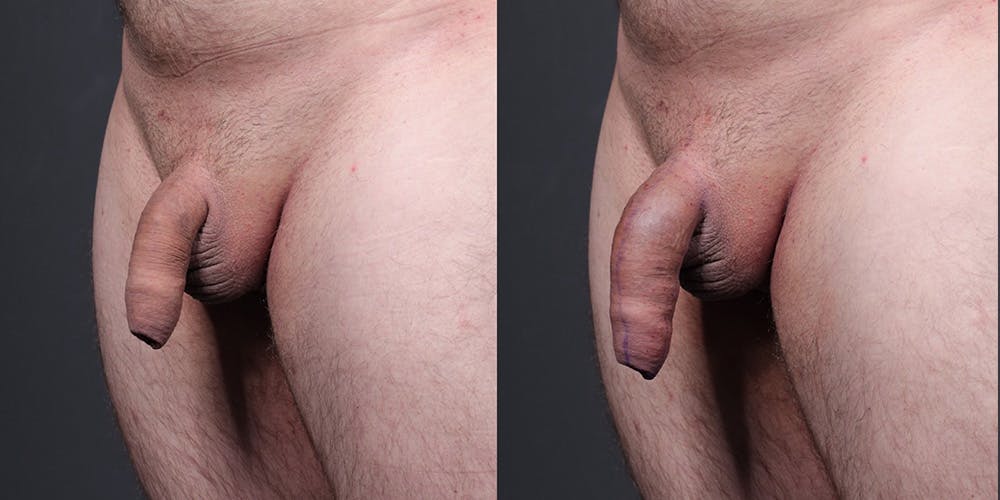 Penis Enhancement Before & After Gallery - Patient 292021 - Image 4