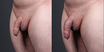 Penis Enhancement Before & After Gallery - Patient 292021 - Image 4