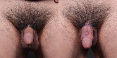 Penis Enhancement Before & After Gallery - Patient 110350 - Image 1