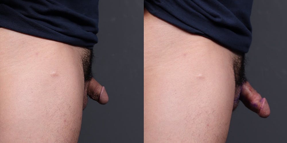 Penis Enhancement Before & After Gallery - Patient 110350 - Image 4