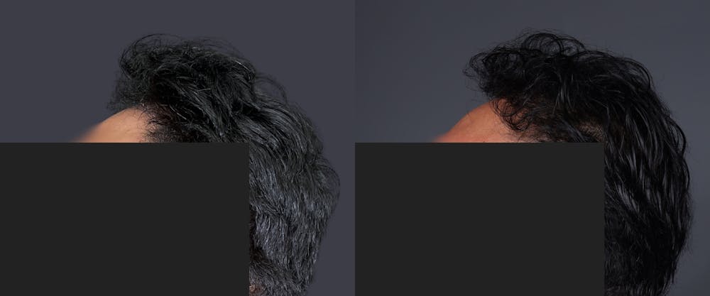Hair Restoration Before & After Gallery - Patient 233815 - Image 3
