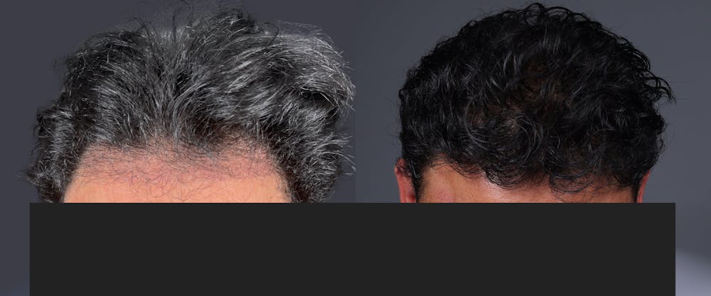 Hair Restoration Before & After Gallery - Patient 233815 - Image 1