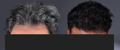 Hair Restoration Before & After Gallery - Patient 233815 - Image 1