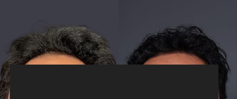 Hair Restoration Before & After Gallery - Patient 233815 - Image 2