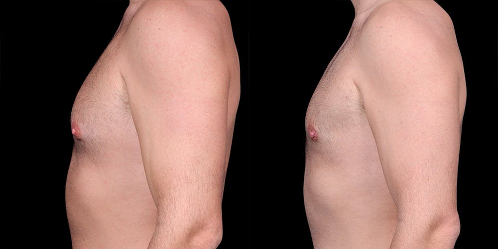 Gynecomastia Before & After Gallery - Patient 374179 - Image 4