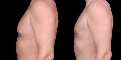 Gynecomastia Before & After Gallery - Patient 374179 - Image 4