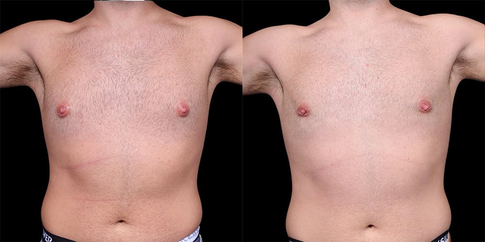 Gynecomastia Before & After Gallery - Patient 374179 - Image 2