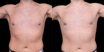Gynecomastia Before & After Gallery - Patient 374179 - Image 2