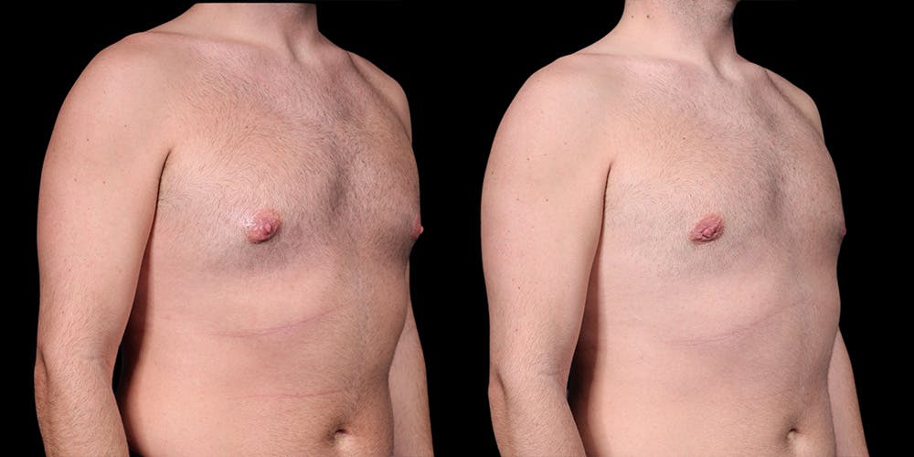 Gynecomastia Before & After Gallery - Patient 374179 - Image 3