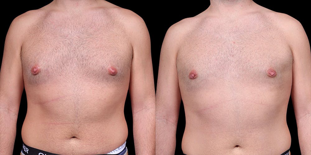 Gynecomastia Before & After Gallery - Patient 374179 - Image 1