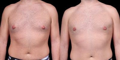Gynecomastia Before & After Gallery - Patient 374179 - Image 1