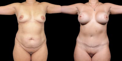 Mommy Makeover Before & After Gallery - Patient 148352120 - Image 1
