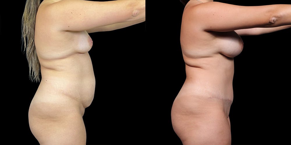 Tummy Tuck Before & After Gallery - Patient 169712 - Image 3