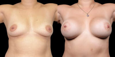 Breast Augmentation Before & After Gallery - Patient 177381 - Image 1