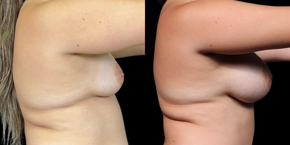 Breast Augmentation Before & After Gallery - Patient 177381 - Image 3