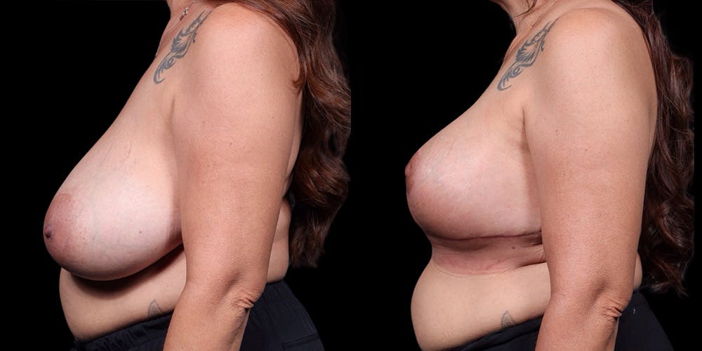 Breast Augmentation Revision Before & After Gallery - Patient 269361 - Image 3