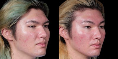 Facial Feminization Surgery Before & After Gallery - Patient 340641 - Image 1