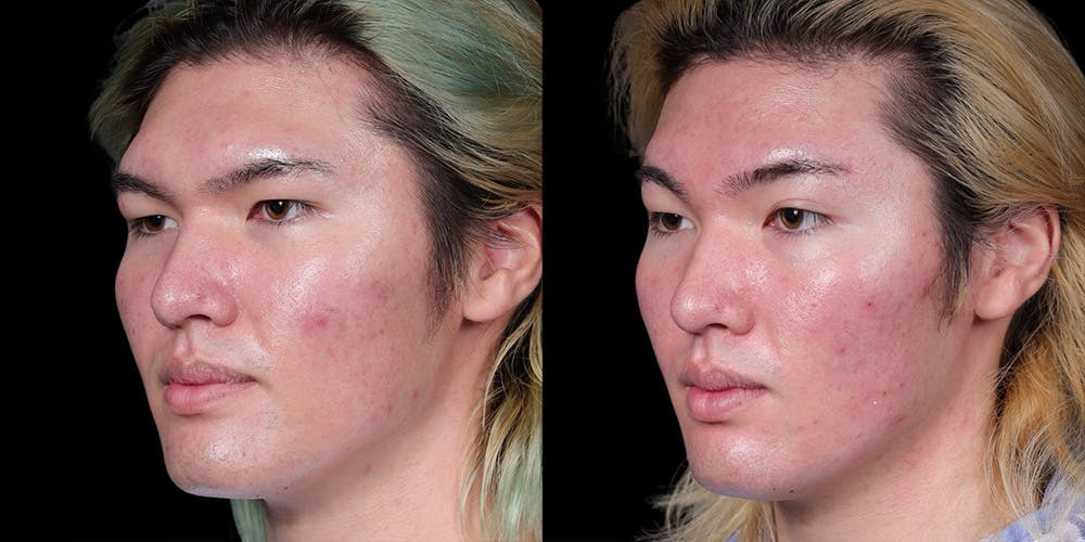 Facial Feminization Surgery Before & After Gallery - Patient 340641 - Image 2
