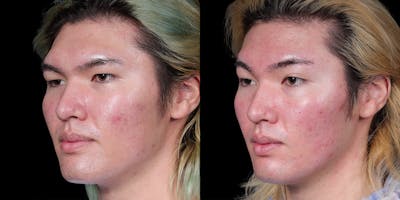 Facial Feminization Surgery Before & After Gallery - Patient 340641 - Image 2