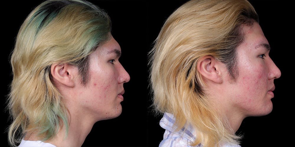 Facial Feminization Surgery Before & After Gallery - Patient 340641 - Image 3