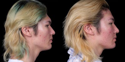 Brow Contouring Before & After Gallery - Patient 415869 - Image 4