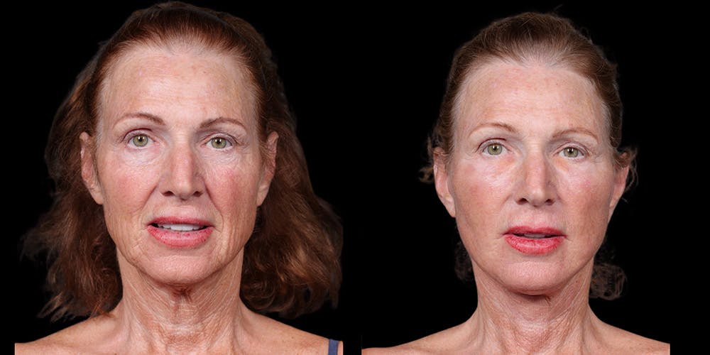 Before and after Facelift surgery in Honolulu with Dr. Shim Ching