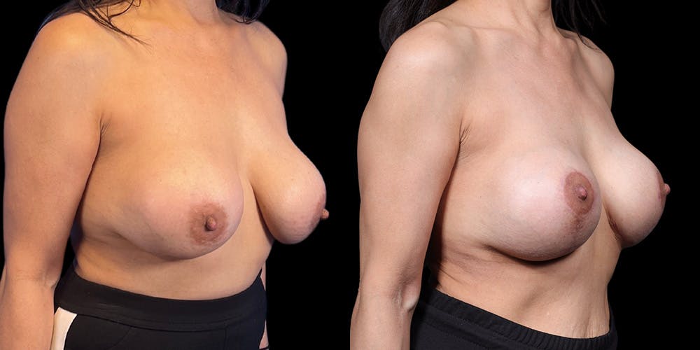 Breast Augmentation Revision Before & After Gallery - Patient 298063 - Image 2