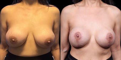 Breast Augmentation Revision Before & After Gallery - Patient 298063 - Image 1