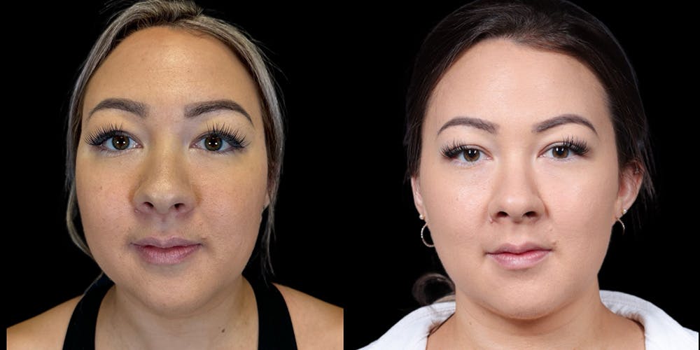 Chin Before & After Gallery - Patient 179752091 - Image 3