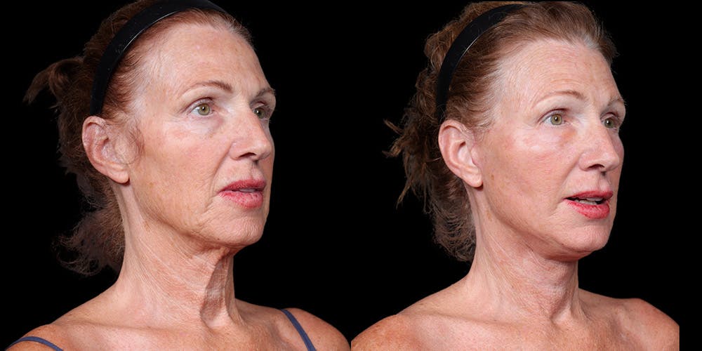 Necklift Before & After Gallery - Patient 348425 - Image 4