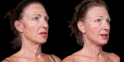Necklift Before & After Gallery - Patient 348425 - Image 4