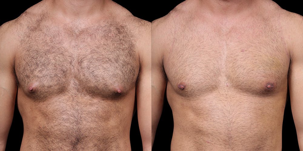 Gynecomastia