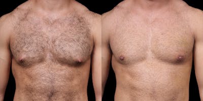 Gynecomastia Before & After Gallery - Patient 121439322 - Image 1