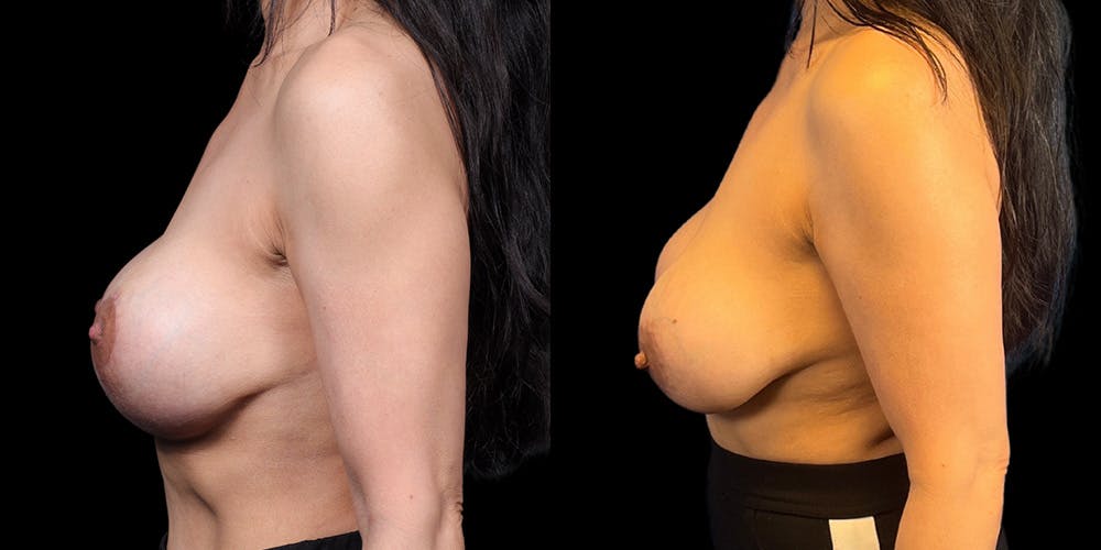 Breast Augmentation Revision Before & After Gallery - Patient 298063 - Image 5