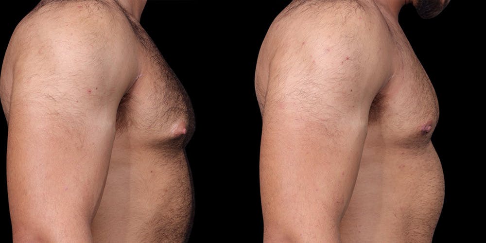 Gynecomastia Before & After Gallery - Patient 121439322 - Image 4