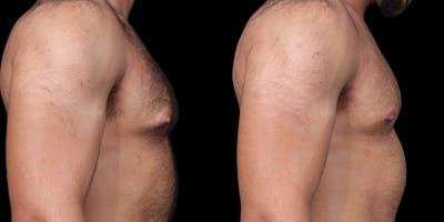 Gynecomastia Before & After Gallery - Patient 121439322 - Image 4