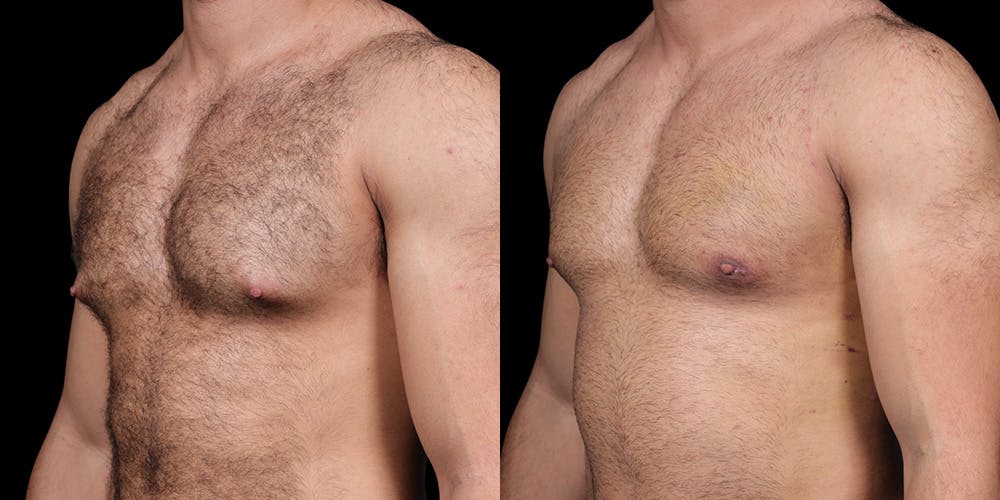 Gynecomastia Before & After Gallery - Patient 121439322 - Image 2