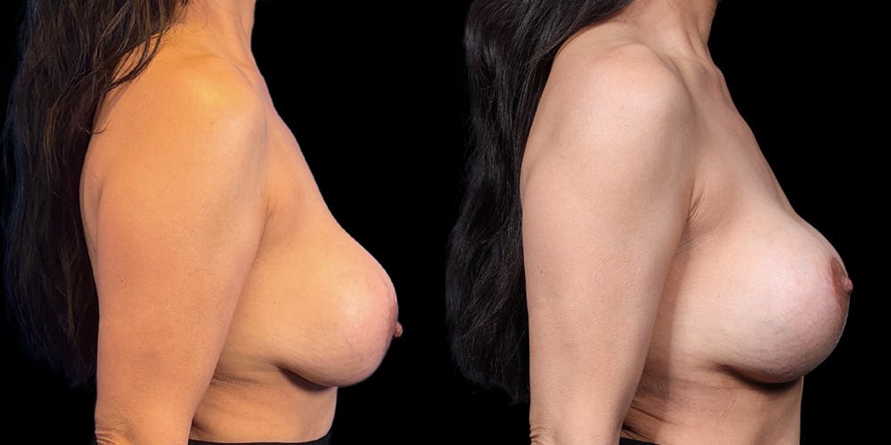 Breast Augmentation Revision Before & After Gallery - Patient 298063 - Image 3