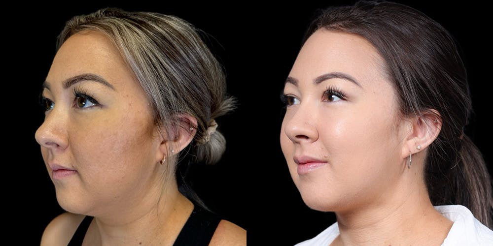 Chin Before & After Gallery - Patient 179752091 - Image 5