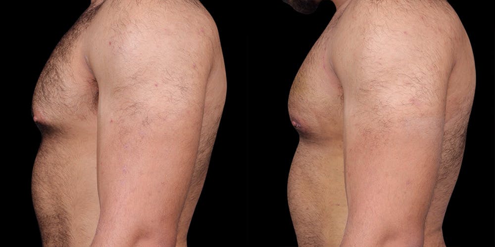 Gynecomastia Before & After Gallery - Patient 121439322 - Image 3