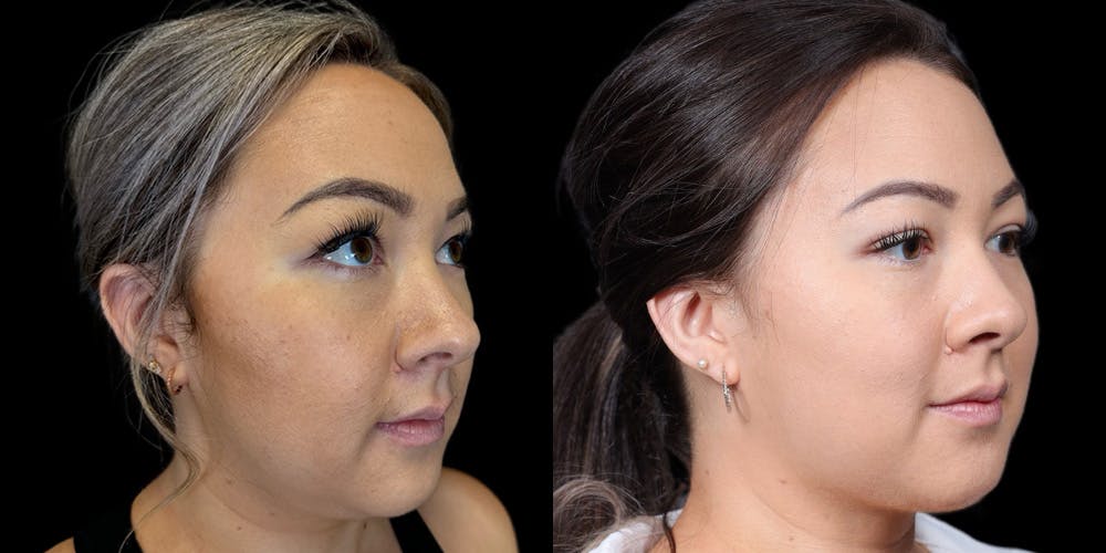 Chin Before & After Gallery - Patient 179752091 - Image 2