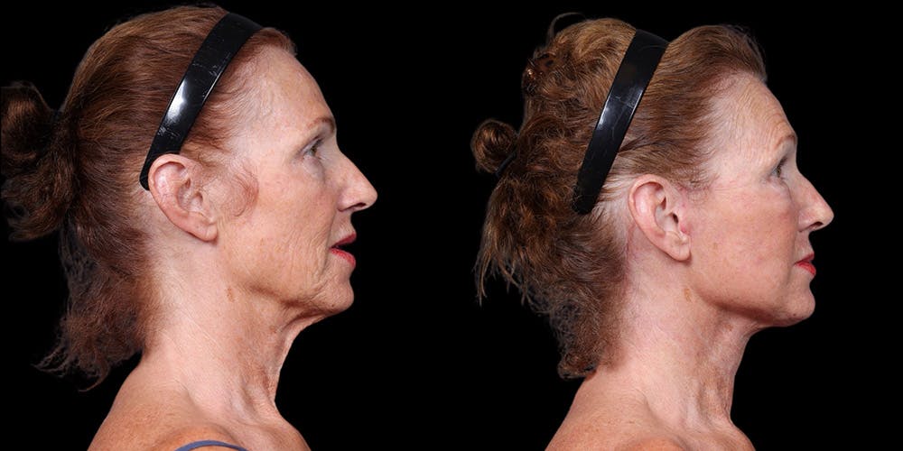 Before and after Neck Lift surgery in Honolulu with Dr. Shim Ching