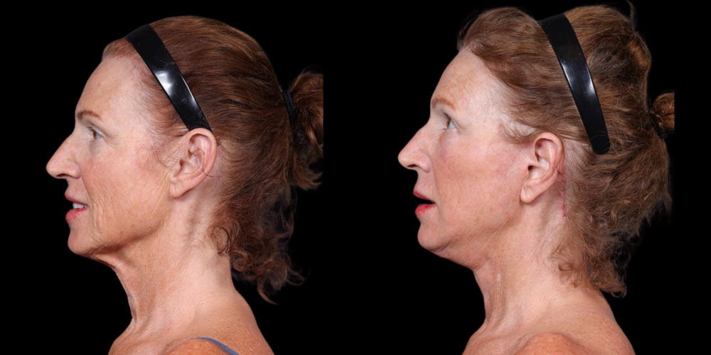 Necklift Before & After Gallery - Patient 348425 - Image 3