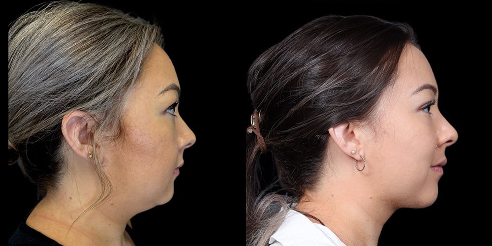 Chin Surgery
