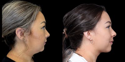 Chin Before & After Gallery - Patient 179752091 - Image 1