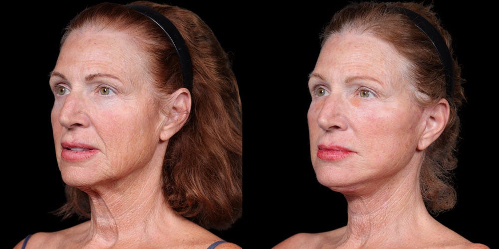 Necklift Before & After Gallery - Patient 348425 - Image 2