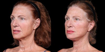 Necklift Before & After Gallery - Patient 348425 - Image 2